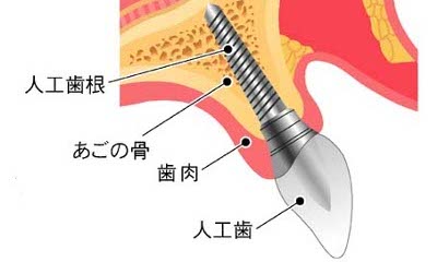 インプラントについて