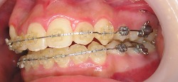 岡山県の歯医者さん・ブラケット矯正