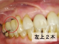 岡山 インプラント 体験