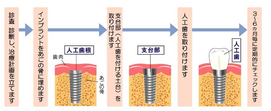 インプラントの手術方法